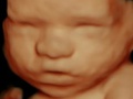 A Little Insight 3d 4d Ultrasound